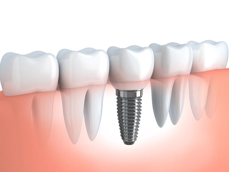 Dental Implants  Dublin, OH 